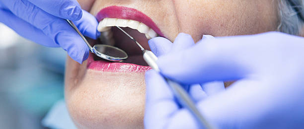 Emergency Dental Filling Replacement in CO
